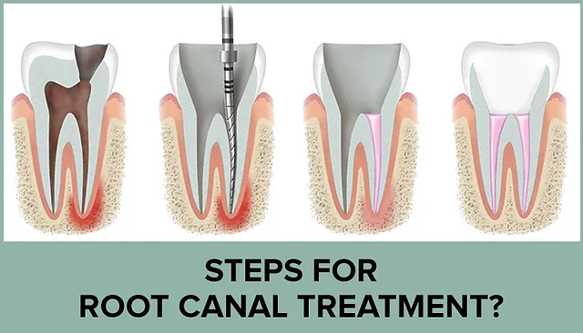 Before and after a root canal treatment performed by Dr. Luis Abrahante at Over the Mountain Dentistry in Mountain Brook. Showcasing minimally invasive techniques to save a decayed tooth and restore it to full function.