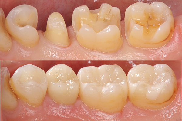 Custom inlay and onlay restorations by Dr. Luis Abrahante at Over the Mountain Dentistry in Mountain Brook, AL.