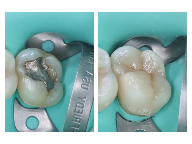 Before and after a dental filling procedure by Dr. Luis Abrahante at Over the Mountain Dentistry in Mountain Brook. Showcasing minimally invasive techniques to restore a decayed tooth with a natural-looking composite filling